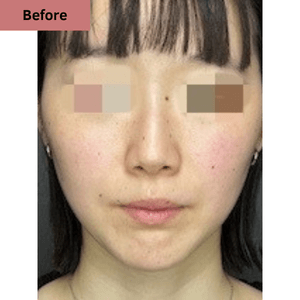 ほくろ取り症例写真➁before
